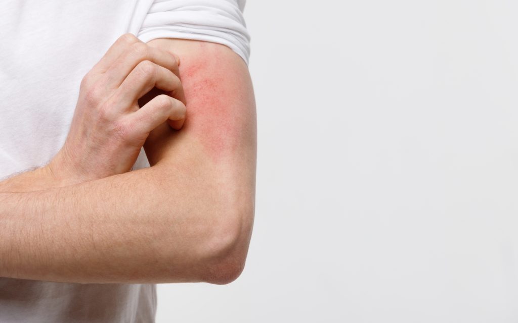 Man itches red rash on arm.